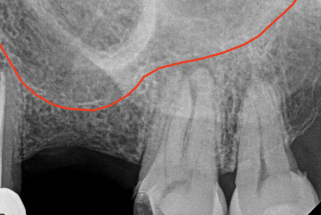 <p>What is the closest root to the maxillary sinus?</p>