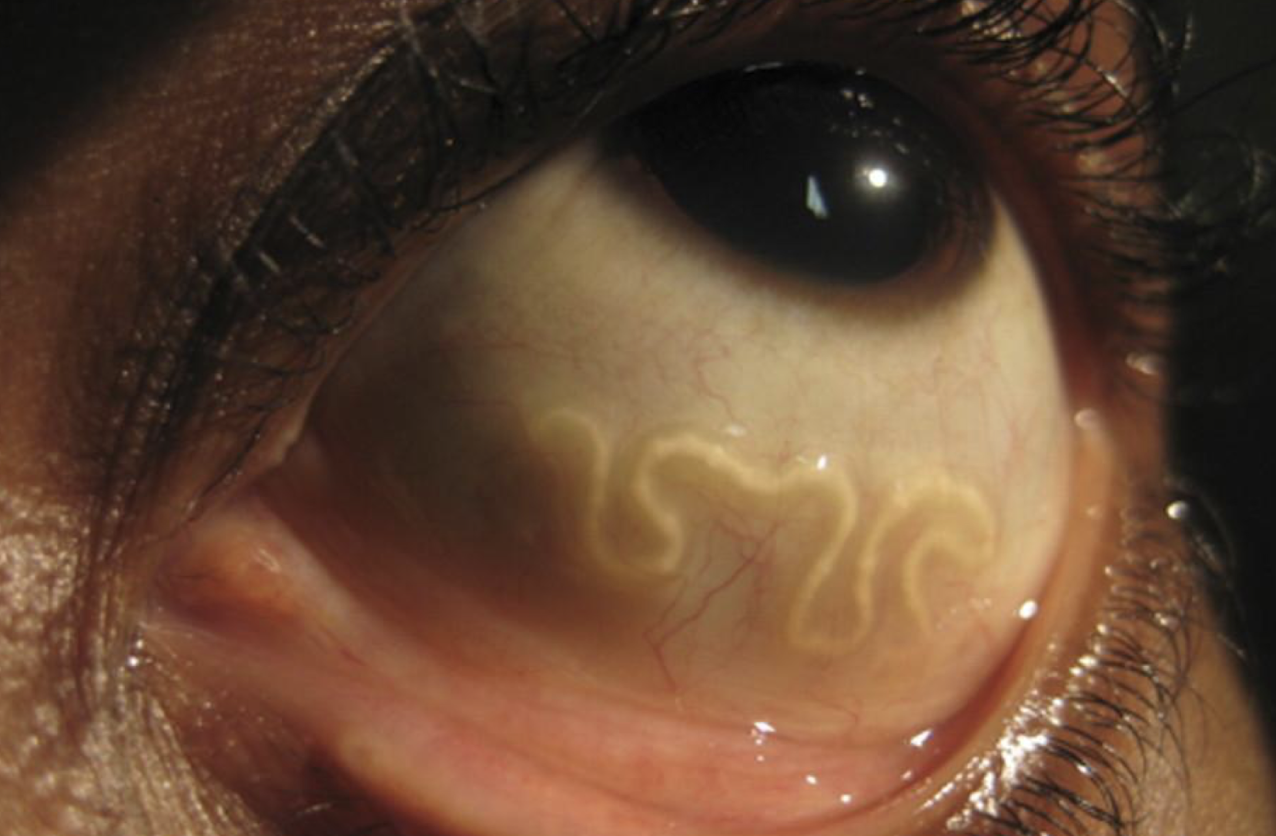 <p>What parasite causes this?</p>