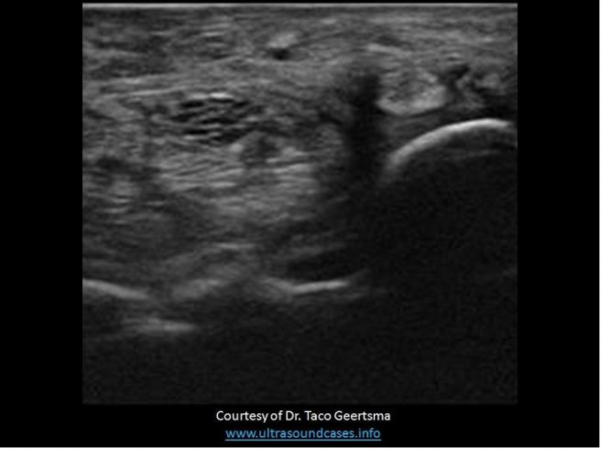 <p>The image demonstrates a transverse view of the wrist. Find the center of the median nerve</p>