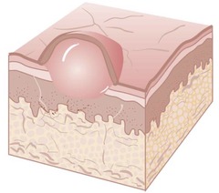 <p>Primary lesion; a small, raised blister that contains clear fluid inside or under the epidermis.</p><p>Herpes virus infection shows vesicles.</p>