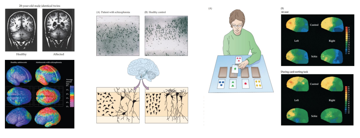 <ul><li><p>Cortical atrophy (temporal cortex, HPC and PFC)</p></li><li><p>Abnormal cell organization (HPC)</p></li><li><p>Hypofrontality</p></li></ul><div data-type="horizontalRule"><hr></div><ul><li><p></p></li></ul><p></p>