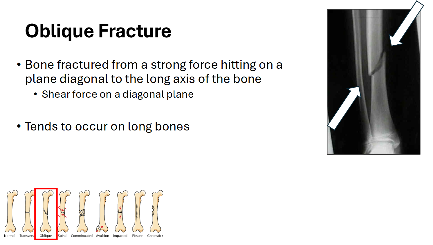 <p>Oblique Fracture</p>
