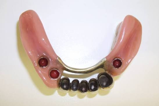 <p>Dental Hybrid Restoration</p>