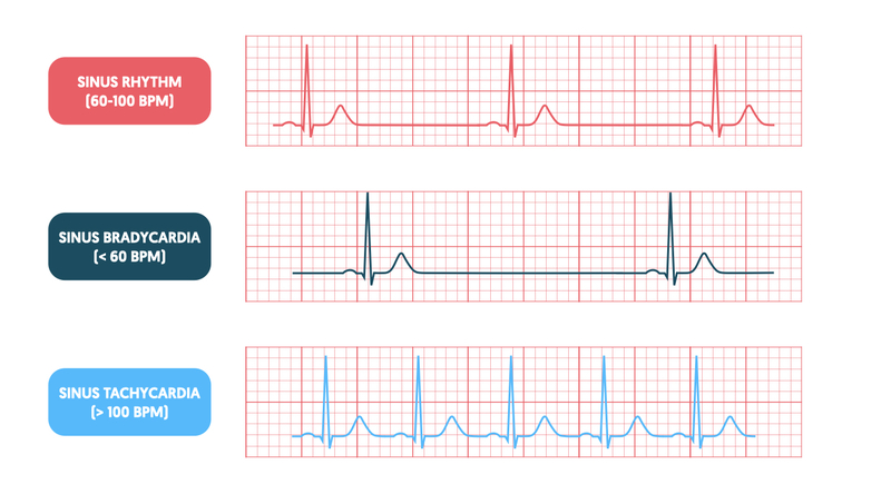<p>Tachycardia:<br><strong>Heart rate > 100 bpm</strong>.<br>ECG shows <strong>QRS complexes closer together</strong>.<br>Heart beats abnormally fast.<br><br>Brachycardia<br><strong>Heart rate < 60 bpm</strong>.<br>ECG shows <strong>QRS complexes further apart</strong>.<br>Heart beats abnormally slowly.</p><p></p>
