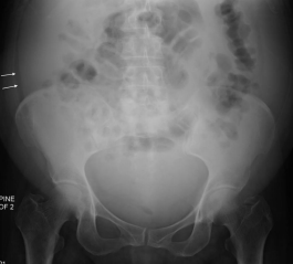 <p>Abnormal accumulation of fluid in the peritoneal cavity of the abdomen</p><ul><li><p>Displaces the bowel centrally</p></li></ul><p></p>