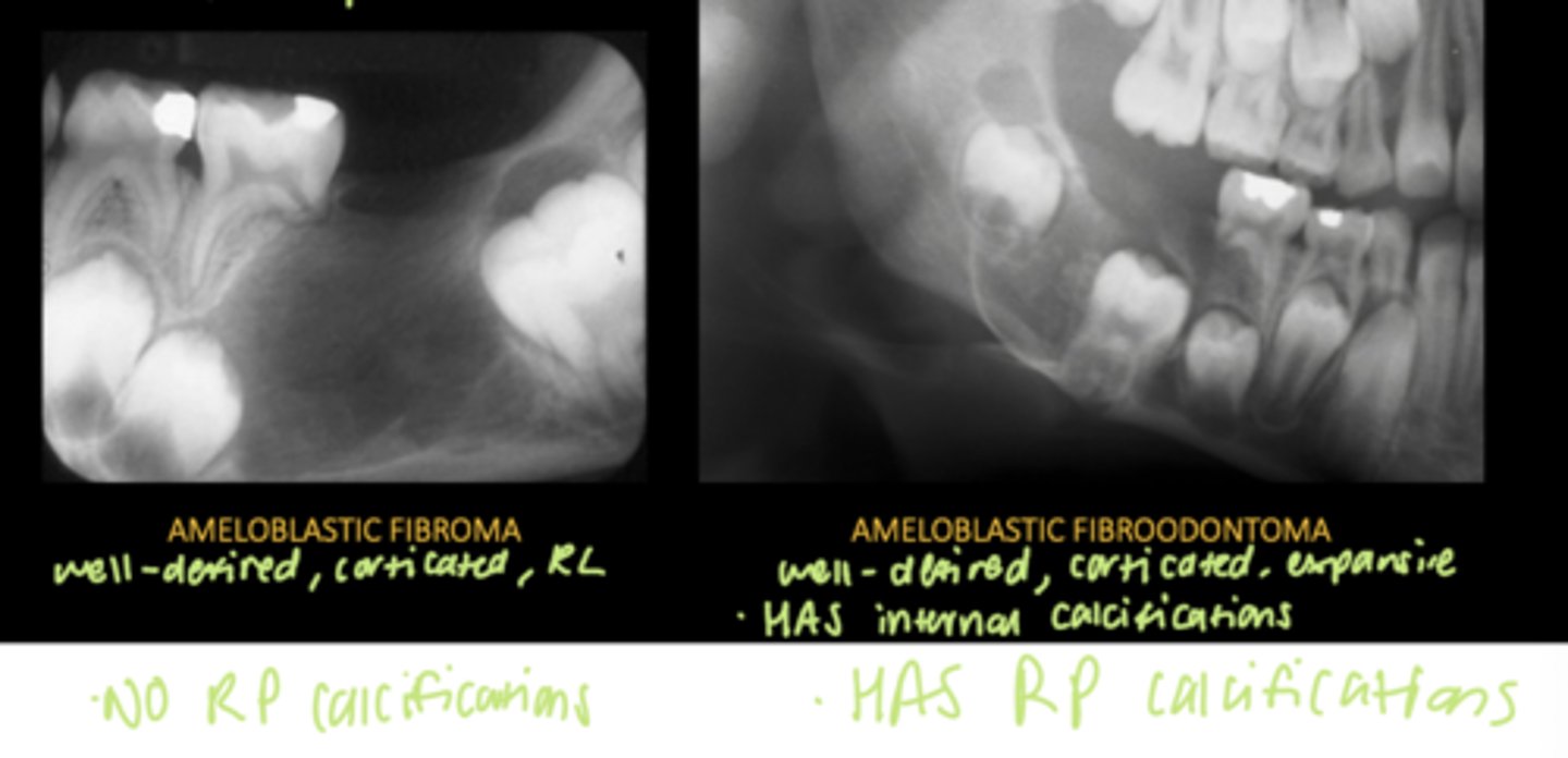 <p>Ameloblastic fibroma:</p><p>- NO RP calcifications</p><p>Ameloblastic fibroodontoma:</p><p>- HAS RP calcifications</p>