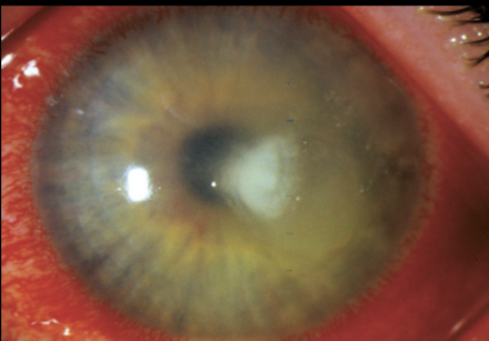 <p>Need to cover major offenders: Staph, Pseudomonas for CL, H flue, MRSA for community acquired</p><ul><li><p>Daytime Rx#1: Besivance 0.6% Ophthalmic suspension; 5mL; instill 1 drop every 5 minutes for 5 doses, then 1 drop q30 min for 6 hours, then 1 drop every hour until instructed otherwise (wake up every hour); No refills; SHAKE WELL BEFORE USE </p></li><li><p>Daytime Rx#2: Polytrim Ophthalmic solution; 10mL; instill 1 drop every hour until instructed otherwise; No refills </p></li><li><p>Nighttime Rx: Tobramycin 0.3% ophthalmic Ung; 3.5g; instill 1/4” strip in eye inside lower eyelide before bed until instructed otherwise; no refills </p></li></ul><p></p>