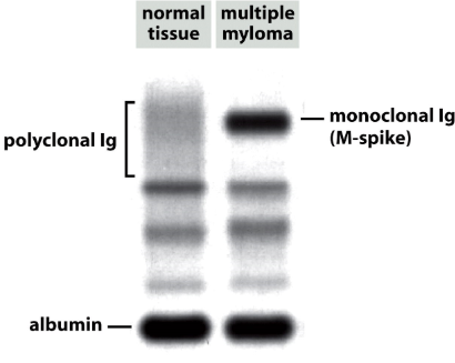 <ul><li><p>Look at the gene glucose-6-phosphate dehydrogenase (G6PD) on X chromosome</p><ul><li><p>Tumors ARE monoclonal</p></li></ul></li></ul><p></p>