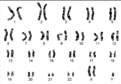 <p>- Karyotype</p><p>Klinefelter XXY shown</p>