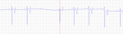 <p>Describe what this ECG is saying?</p>