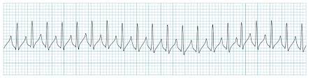 <p>ECG Patterns: SVT</p>