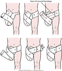 <p>above knee amputation</p>