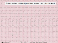 <p>plats QRS</p><p>ritmiska</p>