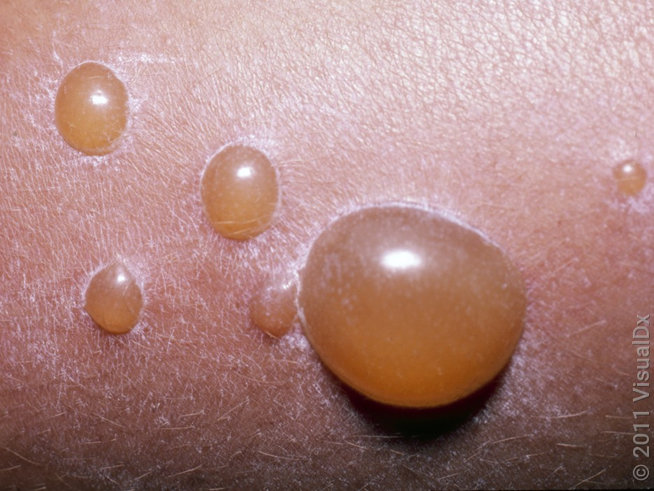 <p>larger pustules surrounded by a small zone of erythema</p><p>highly contagious infection that spread by direct contact, fomites, or autoinoculation</p>
