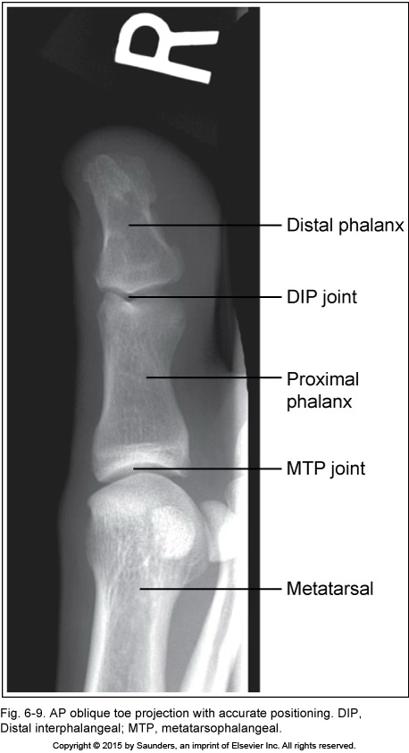 <p>AP oblique toe</p>