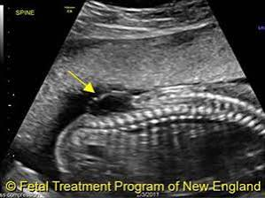 <p>failure of neural tube to close completely </p><p>Occulta </p><ul><li><p>defect covered by tissue </p></li><li><p>normal AFP </p></li><li><p>tuft of hair, dimple </p></li><li><p>rarely seen on US</p></li></ul><p>Aperta</p><ul><li><p>defect uncovered </p></li><li><p>elevated AFP </p></li><li><p>associated with encephalocele, banana sign, lemon shaped head </p></li></ul><p></p>