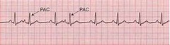 <p>-Extra beat before P wave</p><p>-Pause before next complex after occurs </p><p>-Irregular</p>
