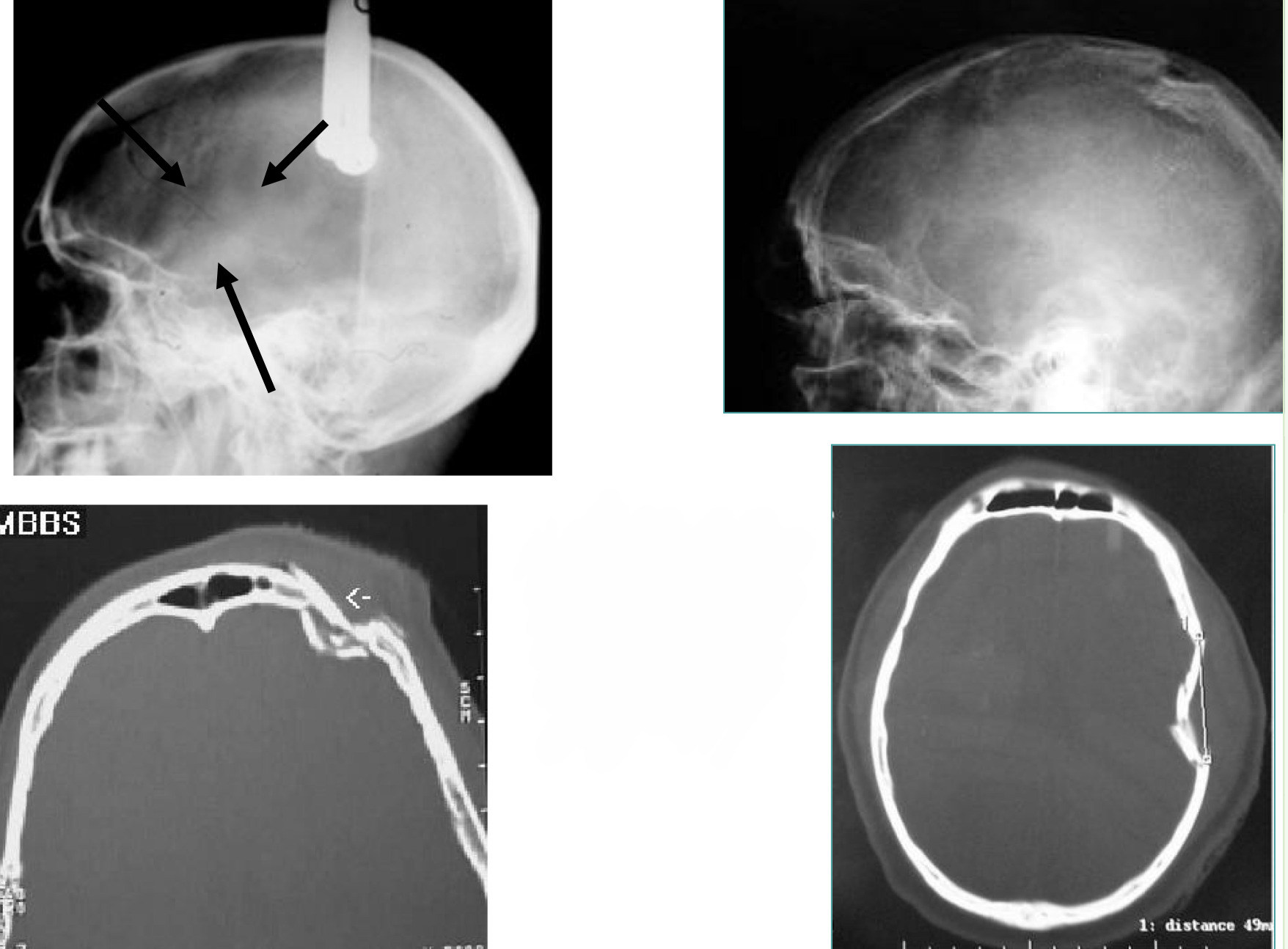 <p>What type of skull fracture is this </p>