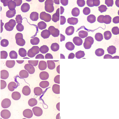 <p>Trypanosoma brucei spp., trypomastigote</p><p>Disease: <u>African sleeping sickness</u></p><p>Vector: <u>Tsetse fly</u></p><p>Transmission: <u>Bite of fly</u></p><p>Infective stage: <u>Metacyclic trypomastigote</u></p><p>Diagnostic stage: <u>Trypomastigote</u></p><p>Treatment: <u>Suramin sodium</u></p>