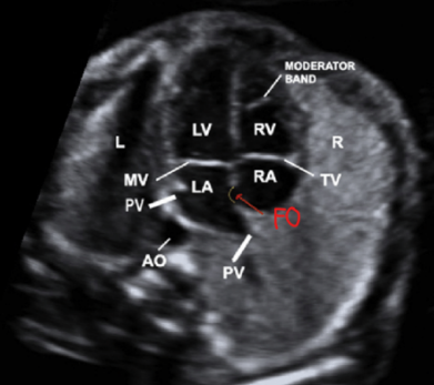 <ul><li><p><span style="background-color: transparent;">Heart is in LT chest and fills ~⅓ of chest cavity</span></p></li><li><p><span style="background-color: transparent;">Apex points ~45° to LT anterior chest wall</span></p></li><li><p><span style="background-color: transparent;">Ventricles are the same size</span></p></li><li><p><span style="background-color: transparent;">FO flap opens into LA</span></p></li><li><p><span style="background-color: transparent;">Moderator band seen in apex of RV</span></p></li><li><p><span style="background-color: transparent;">Valves separating atria and ventricles</span></p></li><li><p><span style="background-color: transparent;">Blood in LV extends fully to apex</span></p></li></ul><p></p>