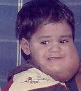<p>cystic hygromas</p>