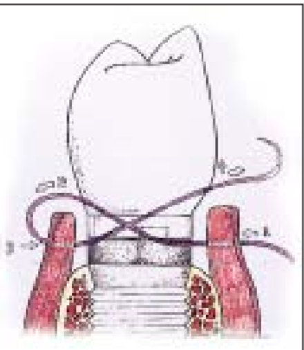 <ul><li><p>often used for socket closure after extraction</p></li><li><p>forms in “X” across the wound</p></li><li><p>provides a secure hemostasis and covers open sockets or membranes</p></li></ul><p></p>