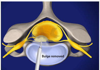 <p><strong>Removal of part or complete herniated disc impacting on spinal nerves</strong></p><p><u>Indications</u>:</p><ul><li><p>Spinal Cord compression, Cauda equina, spinal nerve root compression, radiological imaging, failure of non-operative treatments</p></li></ul><p><u>Contraindications</u>: NIL</p><p><u>Post Operation: </u>Indep mobility, indep ADLs, limited lifting/flexion</p>