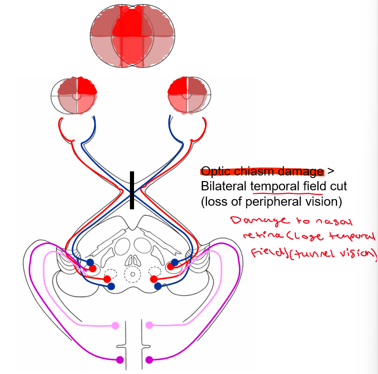 <p>Nasal retina (lose temporal field)</p>