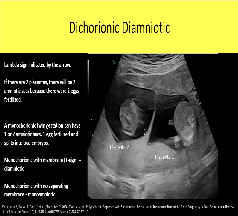 <p>D. will usually demonstrate two chorions, two amnions and two placentas.</p><p>A dizygotic gestation occurs when 2 OVA are fertilized by 2 SPERM.</p><p class="p1">It is the most common type of twins. They always have 2 chorions, 2 amnions, 2 placentas (can appear as one large placenta); The babies can be of the same sex or different.</p>
