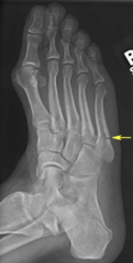 <p>posterior splint, crutches</p>