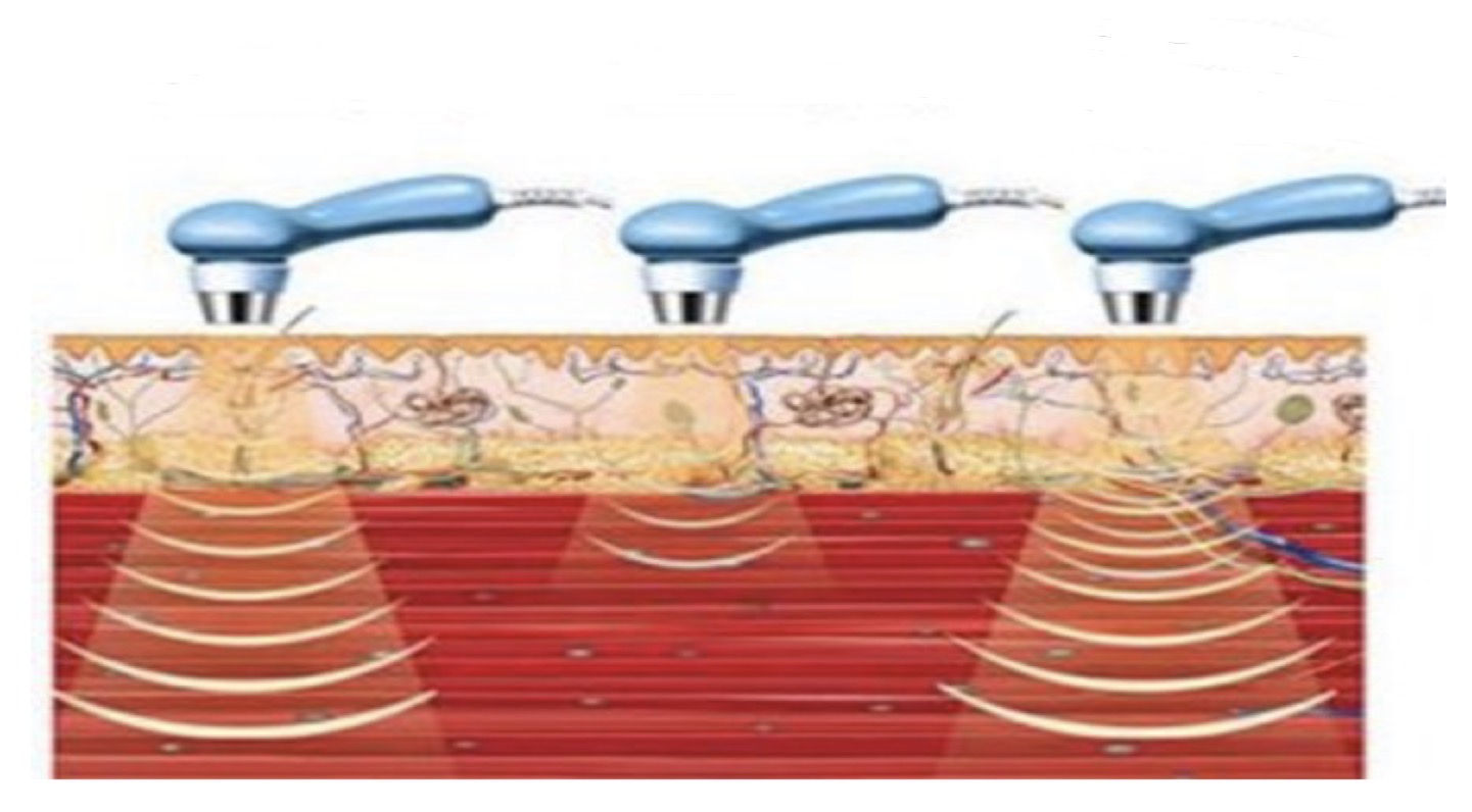 <p>Name this method of physiotherapy</p>