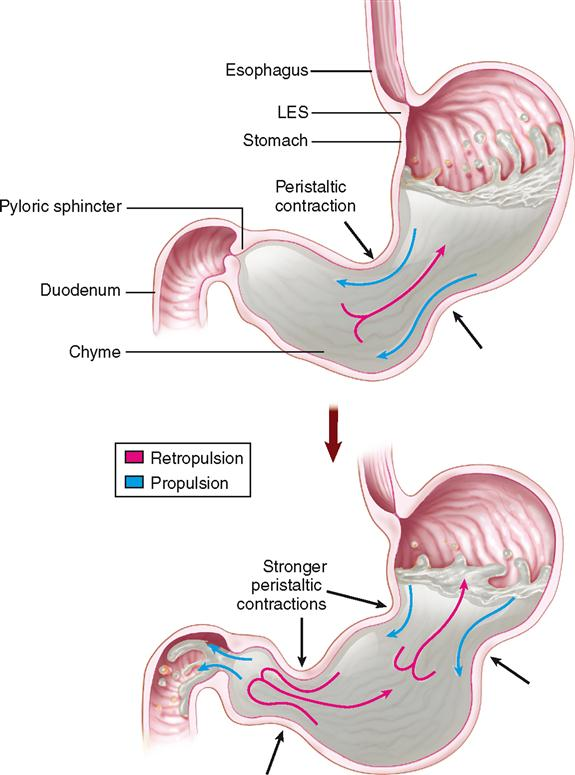 <p>Answer: Backward movement of gastric contents caused when a peristaltic contraction approaches a closed pyloric sphincter.</p><p>Extra Information:</p><ul><li><p>Retropulsion mechanically shears and mixes gastric contents.</p></li></ul><p></p>