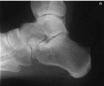 <p><strong>On this lateral calcaneus image, what indicates no rotation?</strong></p>