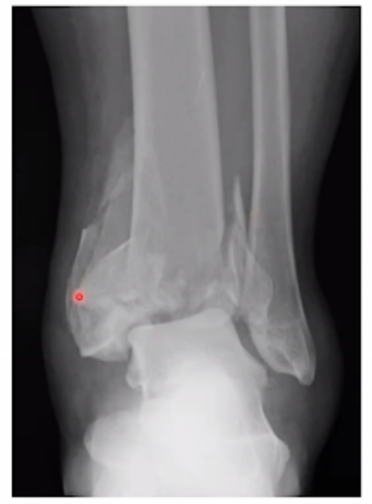 <p>What fracture is this?</p>