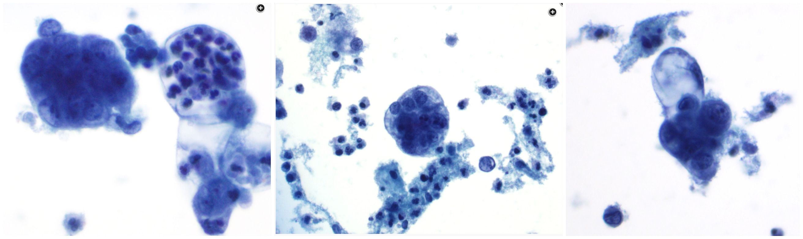 <p>Diagnosis from this Pap smear from 58F</p>