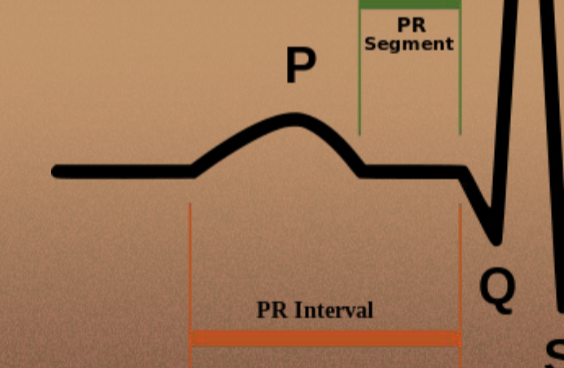<p>P wave - atrial depolarization</p>