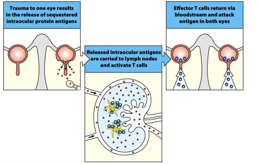 <p>Damage to the eye permits T cells to enter area of immune privilege.</p>