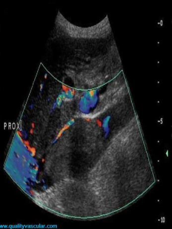 <p>the image demonstrates a complication that is most common with what carcinoma?</p>