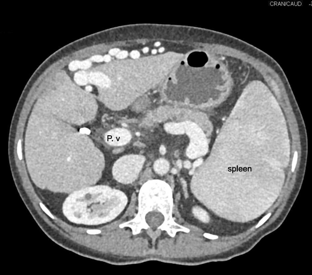 <p><span>Portal hypertension (bulky spleen, dilated portal, splenic veins and collaterals)</span></p>