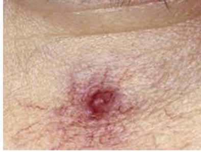 <p>Telangiectsias, nevus flammeus, mancha de vino oporto y telangiectasias aranoides (embarazadas)</p>