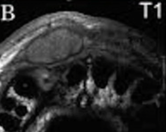 <p>benign or malignant?</p>