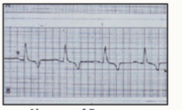 <ul><li><p>hyperkalaemia</p></li></ul><p></p>
