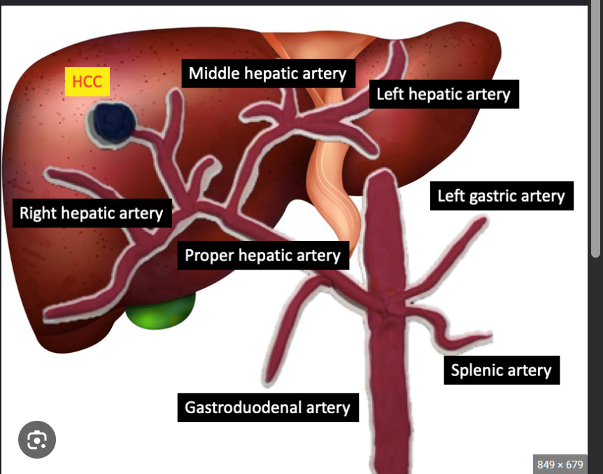 <p>It is imaged through the <strong>intercostal window</strong> at the <strong>porta hepatis</strong>.</p><p></p><p>The <strong>porta hepatis</strong> is the liver’s <strong>main doorway</strong>.</p><p>It is an area where important tubes and blood vessels enter or leave the liver:</p><ul><li><p><strong>Portal vein enters</strong></p></li><li><p><strong>Hepatic artery enters</strong></p></li><li><p><strong>Bile duct leaves</strong></p></li></ul><p>Think of the liver like a building and the porta hepatis is the <strong>front entrance where the plumbing and blood vessels pass through</strong>.</p><p>The hepatic veins do <strong>not</strong> leave through the porta hepatis; they drain from the liver directly into the IVC.</p>