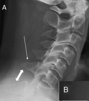 <p>Facets - Unilateral Subluxation</p>
