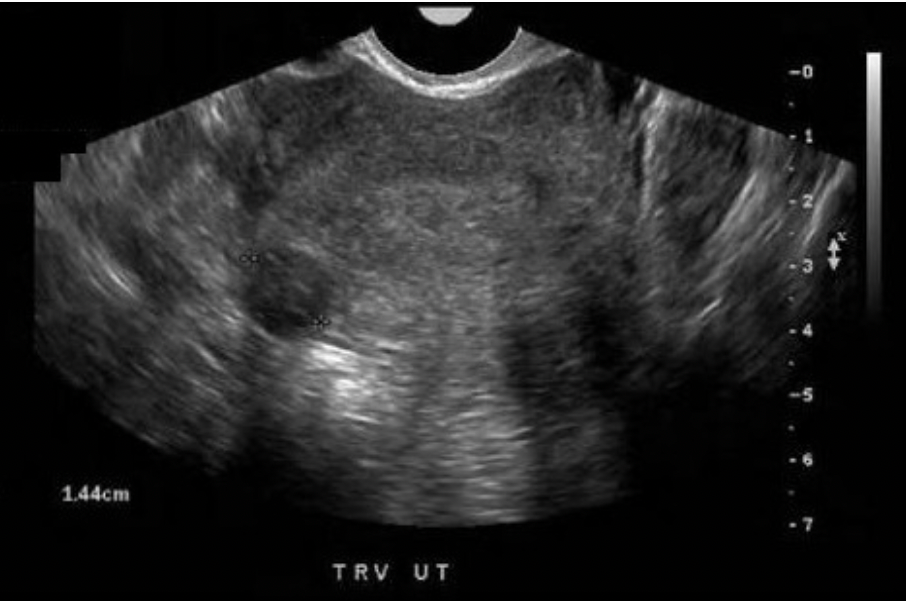 <p>What type of fibroid is seen on the image displayed?</p><p>A. submucosal</p><p class="p1">B. pedunculated</p><p class="p1">C. intramural</p><p class="p1">D. subserosal</p>
