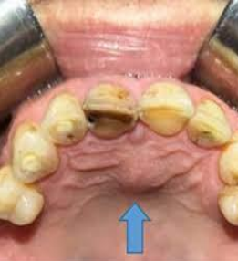 <p>32 year old male patient with complaint of swelling in midline of palate of 3 months duration. There is no pain or any other symptoms. Provide differential diagnosis and justify</p>