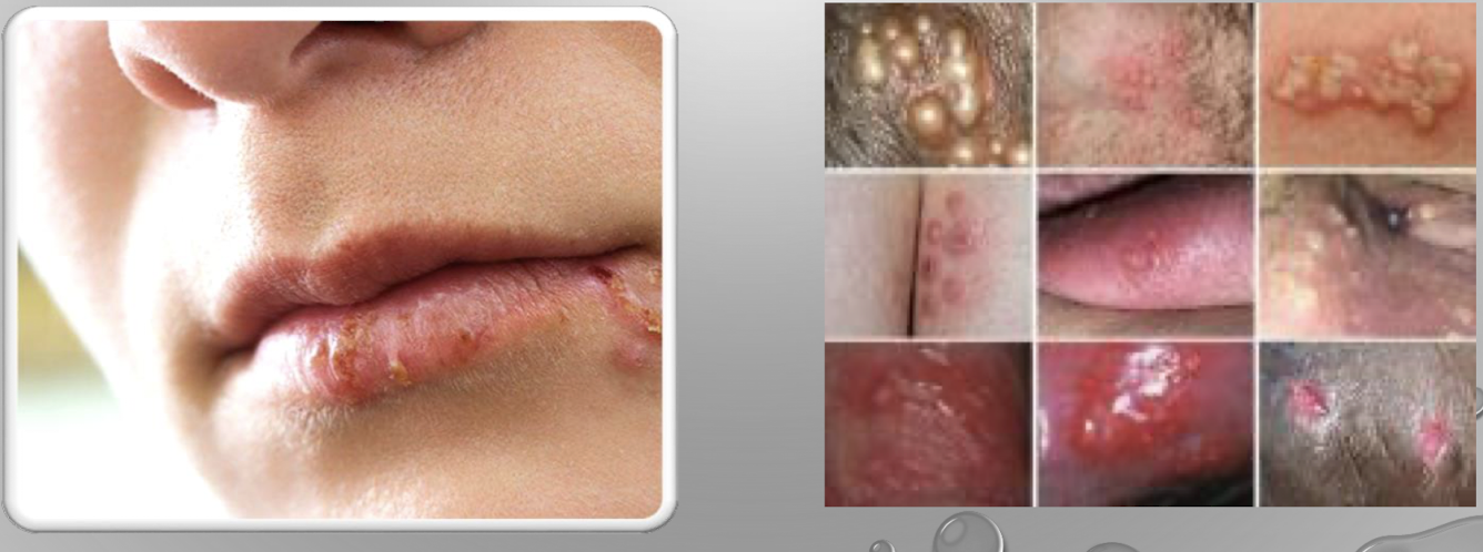 <p>recurrent, lifelong viral infection; worsened by sunlight, trauma, menses, stress, systemic infection; contagious, can be transmitted from one area to another by contact. </p><p>HSV1: primarily on mouth (cold sore, fever blisters)</p><p>HSV2: primarily found on the genitalia (genital warts) </p><p>symptoms: firstâ develop 2days-2weeks after contact; itchy, painful vesicles may form and become pustules and burst, weep, then crust, lesions last 2-6 weeks, contagious; recurrentâ similar spot, same symptoms. </p><p>treatment: soothing, moist compresses, topical agents (abreva); antiviral oral agents: acyclovir (Zovirax), valacyclovir (Valtrex) </p>