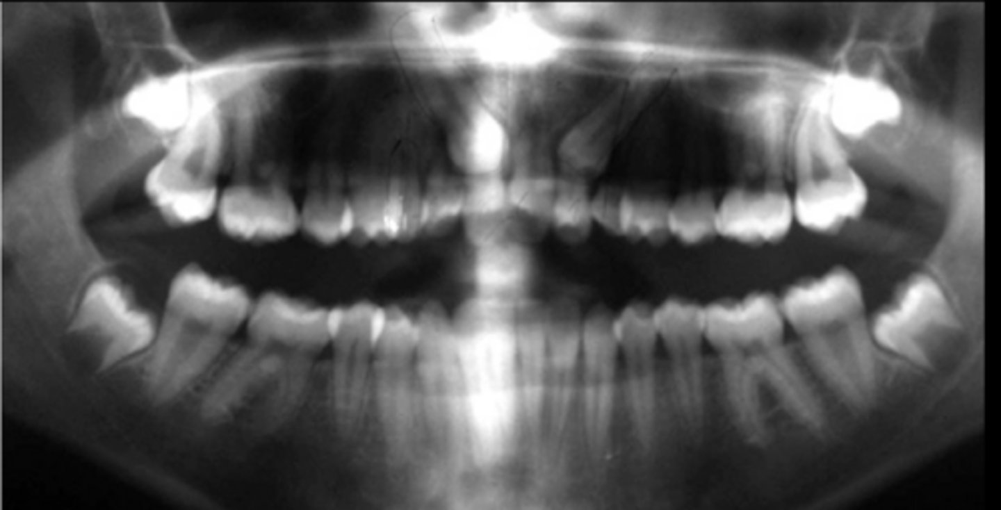 <p>This image shows bilaterally impacted canines. Do you think the patient's left canine is palatally or labially displaced?</p>