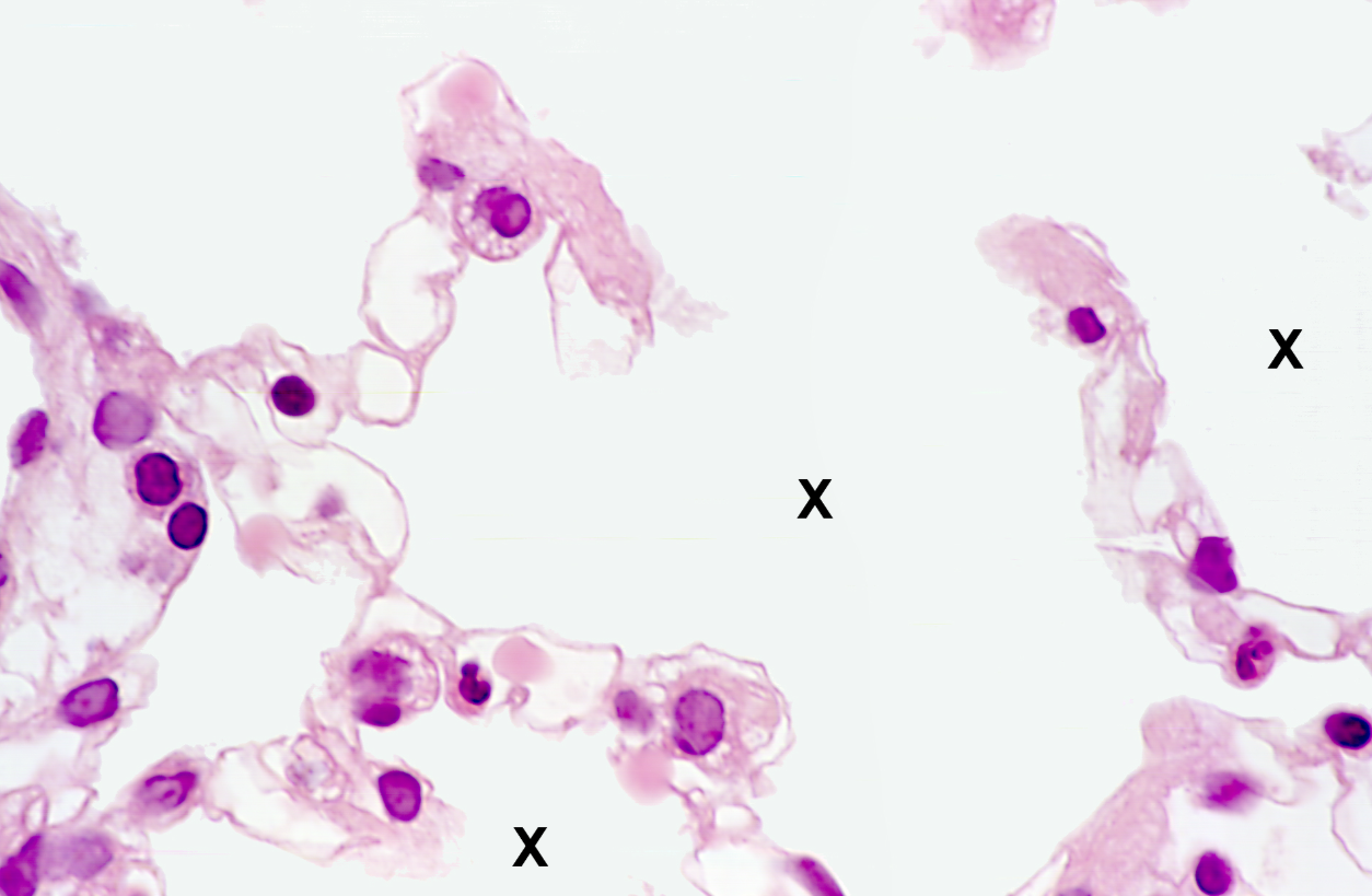 <p>Lung tissue</p><p><strong>NOTICE: THE OPEN SPACE OF THE ALVEOLI</strong></p>