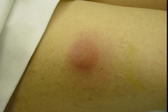 <p>A. incision and drainage with a linear incision</p><p>The answer is A. A fluctuant, indurated area such as that pictured and described, tends to not respond to antibiotics (which cannot penetrate well into the abscess cavity). Cruciate incisions are unnecessary and risk wound healing problems. A 30-gauge needle is too small, and needle drainage of an abscess in this location is not generally used (it is more likely appropriate in facial abscesses).</p>